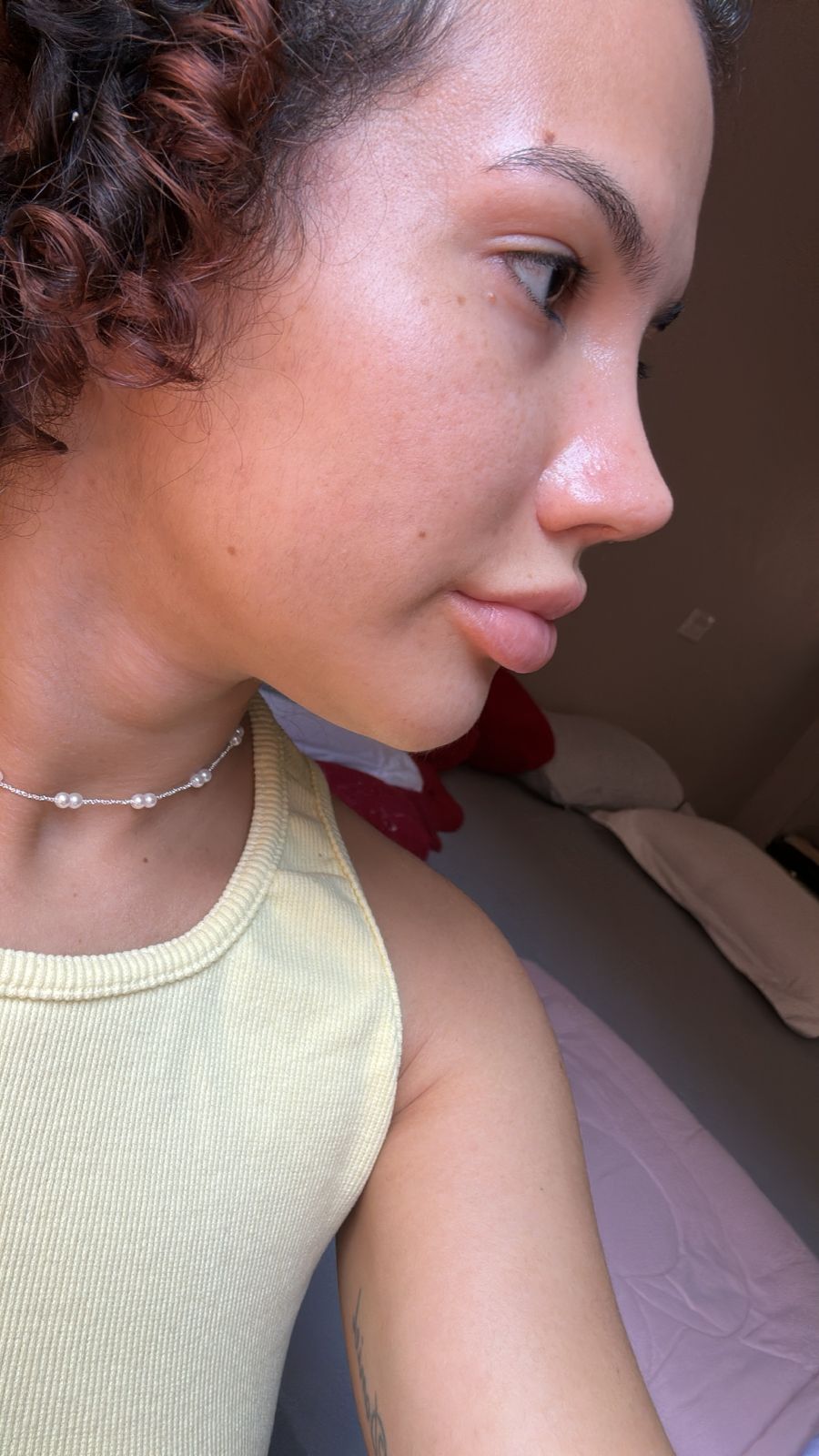 Rinoplastia — antes da cirurgia, caso 2