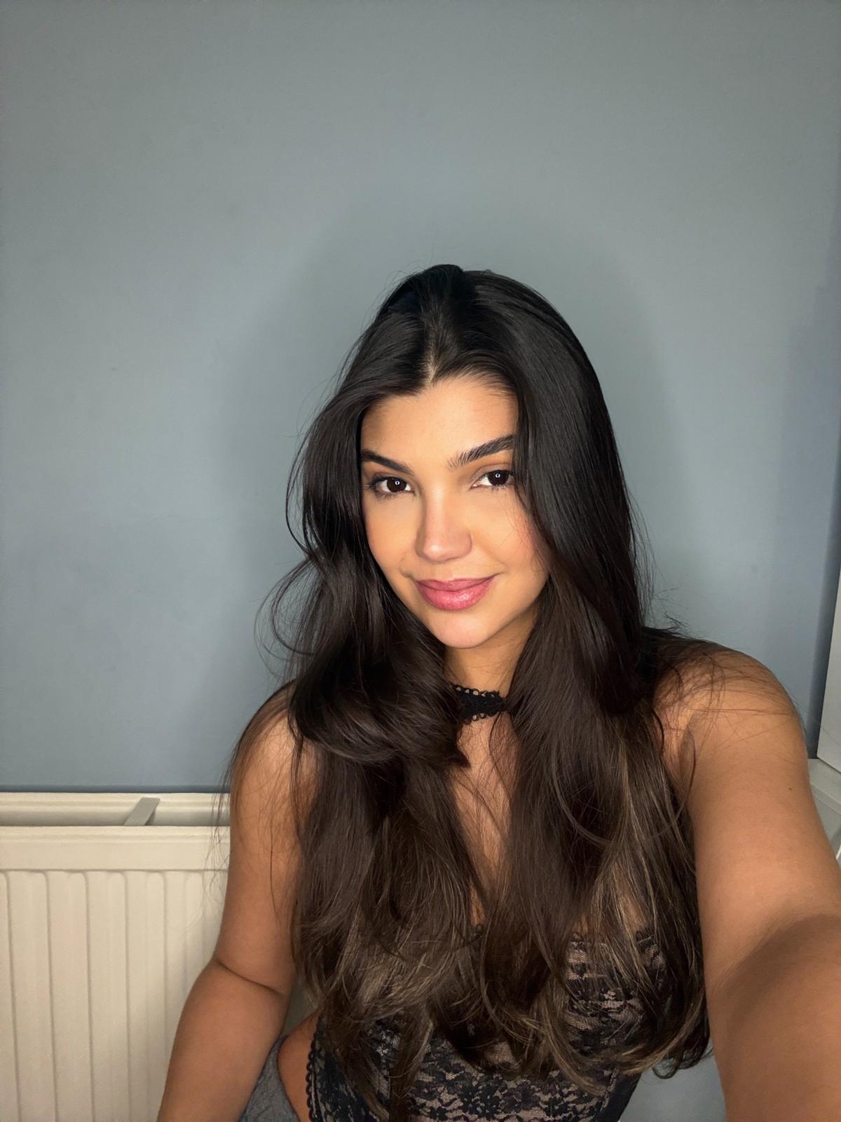 Rinoplastia — resultado depois da cirurgia, caso 3