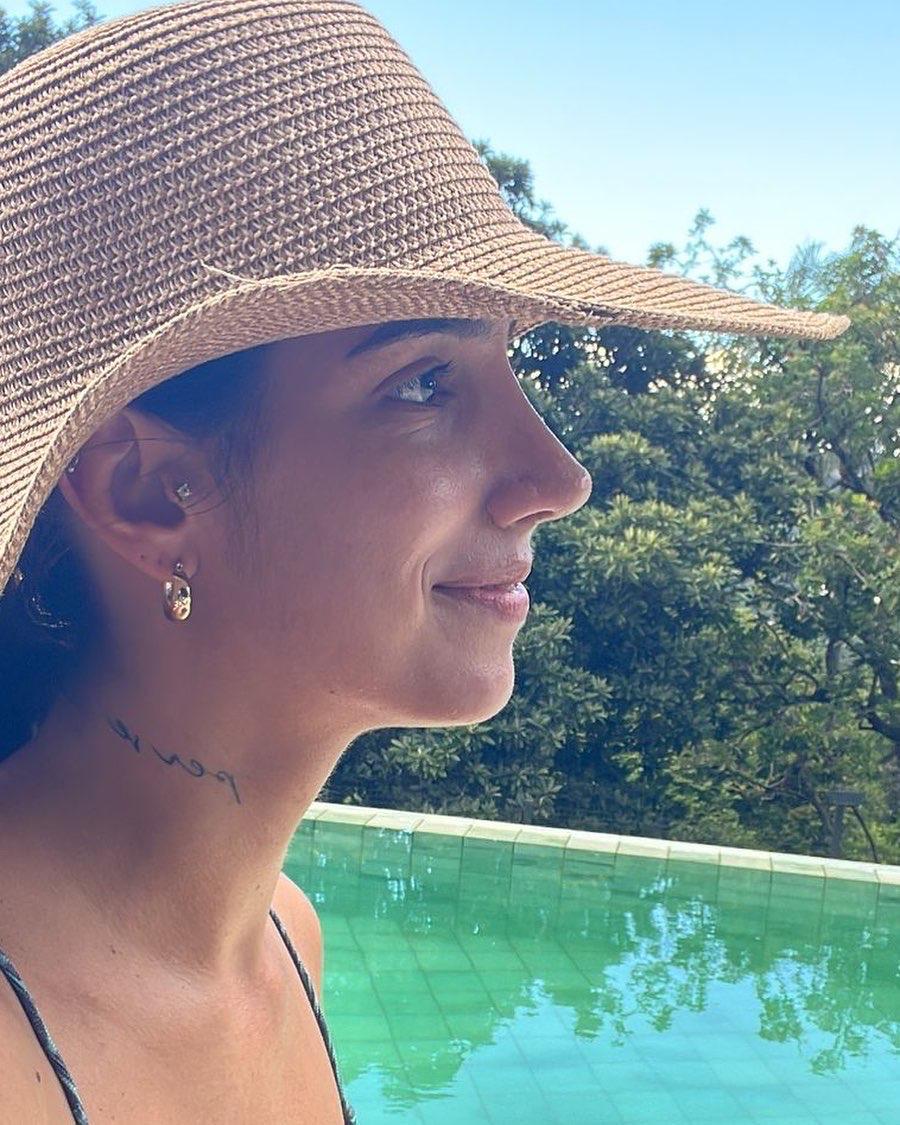 Rinoplastia — resultado depois da cirurgia, caso 5