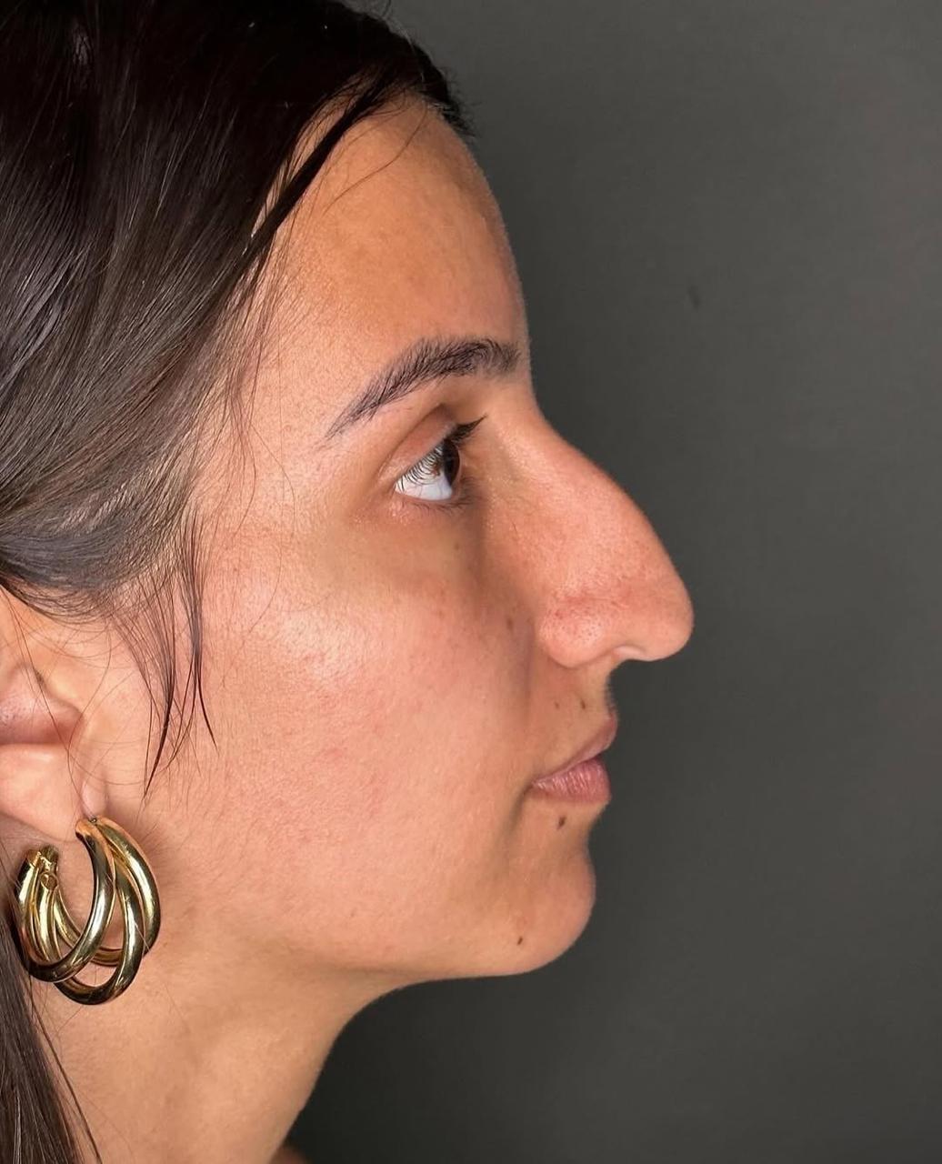 Rinoplastia — antes da cirurgia, caso 5