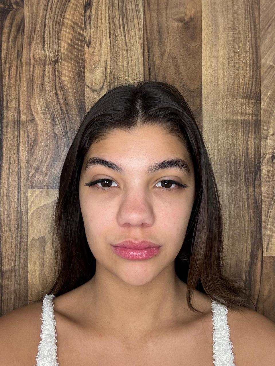 Rinoplastia — antes da cirurgia, caso 3