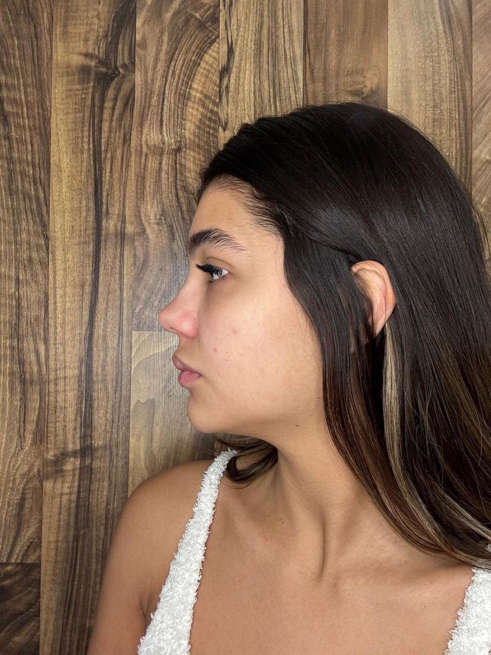 Rinoplastia — antes da cirurgia, caso 4