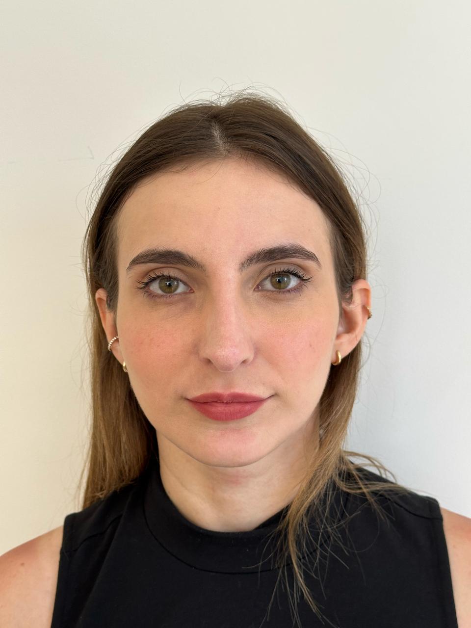 Rinoplastia — antes da cirurgia, caso 1
